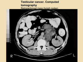 Testicular cancer. Computed
tomography
Retroperitoneal mass (lymph nodes)
 