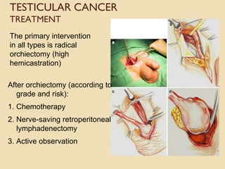TESTICULAR CANCER
TREATMENT
The primary intervention
in all types is radical
orchiectomy (high
hemicastration)
After orchiectomy (according to
grade and risk):
1. Chemotherapy
2. Nerve-saving retroperitoneal
lymphadenectomy
3. Active observation
 