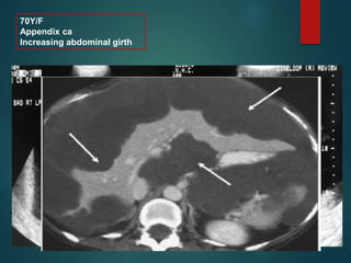 .
70Y/F
Appendix ca
Increasing abdominal girth
 