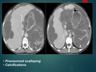 • Pronounced scalloping
• Calcifications.
 