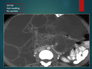 30Y/M
Abd swelling
No ascities
 