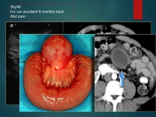 30y/M
h/o car accident 8 months back
Abd pain
 