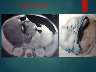 Cystic teratoma….
 