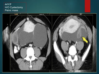 44Y/F
H/O Cystectomy
Pelvic mass
 