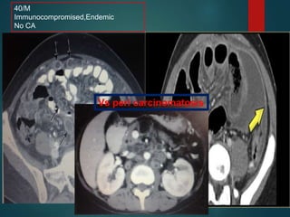 40/M
Immunocompromised,Endemic
No CA
Vs peri carcinomatosis
 