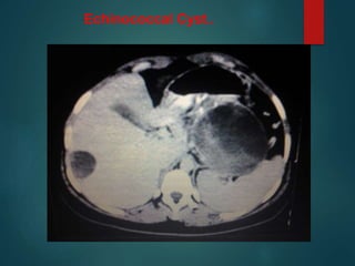 Echinococcal Cyst..
 