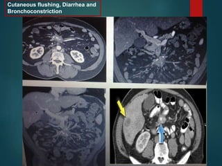 Cutaneous flushing, Diarrhea and
Bronchoconstriction
 