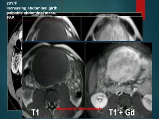 20Y/F
increasing abdominal girth
palpable abdominal mass.
FAP
Mesenteric fibromatosis
 