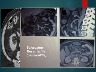 Sclerosing
Mesenteritis
(panniculitis).
 