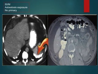 50/M
Asbestosis exposure
No primary
 