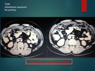 70/M
Asbestosis exposure
No primary
Vs peritoneal carcinomatosis
 