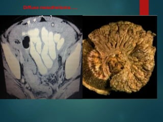 Diffuse mesothelioma…..
 