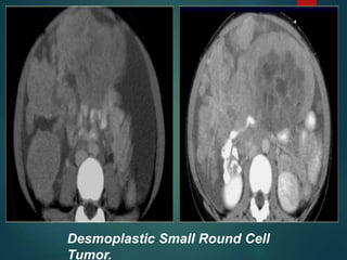 Desmoplastic Small Round Cell
Tumor.
 