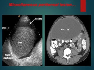 Miscellaneous peritoneal lesion…
 