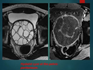 Hydatid cyst at the pelvic
peritoneum.
 