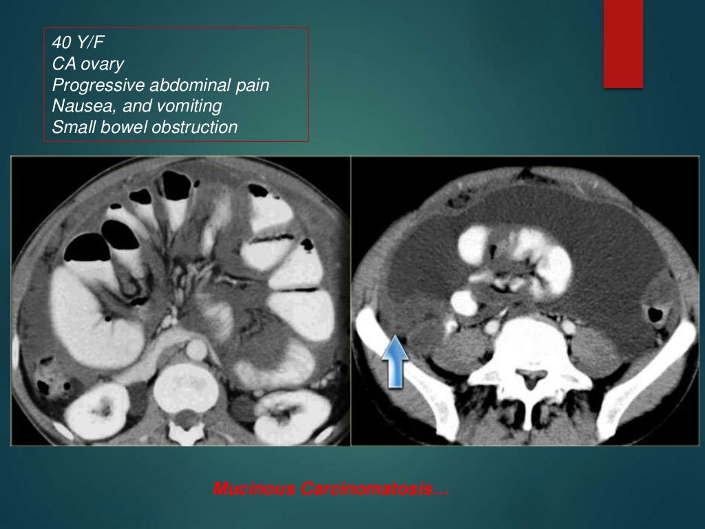 Peritoneum Anatomy and pathology part 2