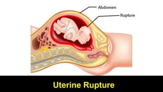 Uterine Rupture
 