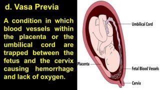 d. Vasa Previa
A condition in which
blood vessels within
the placenta or the
umbilical cord are
trapped between the
fetus and the cervix
causing hemorrhage
and lack of oxygen.
 