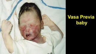 Vasa Previa
baby
 
