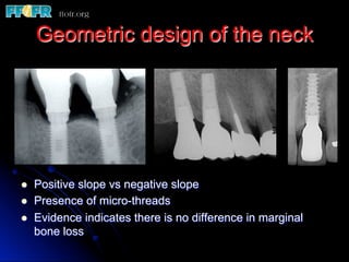 Geometric design of the neck
l  Positive slope vs negative slope
l  Presence of micro-threads
l  Evidence indicates there is no difference in marginal
bone loss
 