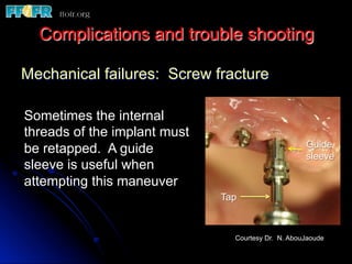 Complications and trouble shooting
Mechanical failures: Screw fracture
Sometimes the internal
threads of the implant must
be retapped. A guide
sleeve is useful when
attempting this maneuver
Guide
sleeve
Tap
Courtesy Dr. N. AbouJaoude
 