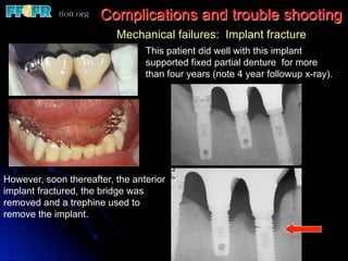 This patient did well with this implant
supported fixed partial denture for more
than four years (note 4 year followup x-ray).
However, soon thereafter, the anterior
implant fractured, the bridge was
removed and a trephine used to
remove the implant.
Complications and trouble shooting
Mechanical failures: Implant fracture
 