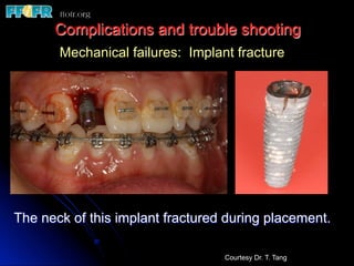 Complications and trouble shooting
The neck of this implant fractured during placement.
Mechanical failures: Implant fracture
Courtesy Dr. T. Tang
 