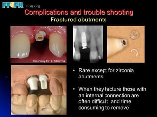 Complications and trouble shooting
Fractured abutments
•  Rare except for zirconia
abutments.
•  When they facture those with
an internal connection are
often difficult and time
consuming to remove
Courtesy Dr. A. Sharma
 