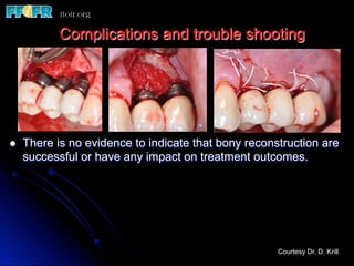 l  There is no evidence to indicate that bony reconstruction are
successful or have any impact on treatment outcomes.
Complications and trouble shooting
Courtesy Dr. D. Krill
 
