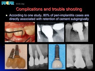 l  According to one study, 80% of peri-implantitis cases are
directly associated with retention of cement subgingivally
Complications and trouble shooting
 