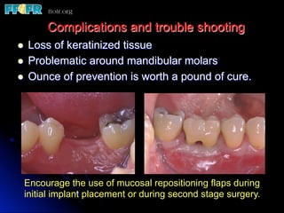 l  Loss of keratinized tissue
l  Problematic around mandibular molars
l  Ounce of prevention is worth a pound of cure.
Complications and trouble shooting
Encourage the use of mucosal repositioning flaps during
initial implant placement or during second stage surgery.
 