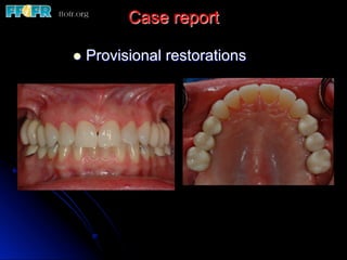 Case report
l  Provisional restorations
 