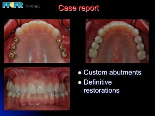 Case report
l  Custom abutments
l  Definitive
restorations
 