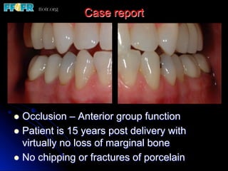 Case report
l  Occlusion – Anterior group function
l  Patient is 15 years post delivery with
virtually no loss of marginal bone
l  No chipping or fractures of porcelain
 