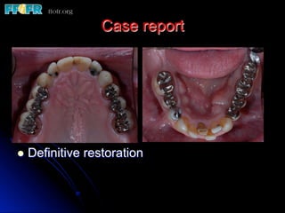 Case report
l  Definitive restoration
 
