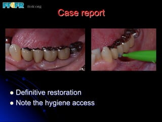 Case report
l  Definitive restoration
l  Note the hygiene access
 