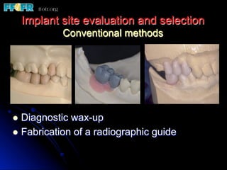 Implant site evaluation and selection
Conventional methods
l  Diagnostic wax-up
l  Fabrication of a radiographic guide
 