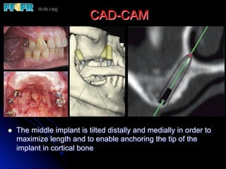l  The middle implant is tilted distally and medially in order to
maximize length and to enable anchoring the tip of the
implant in cortical bone
CAD-CAM
 
