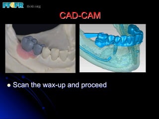 CAD-CAM
l  Scan the wax-up and proceed
 