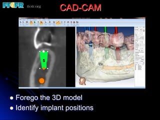 CAD-CAM
l  Forego the 3D model
l  Identify implant positions
 