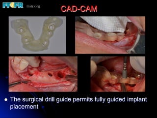 CAD-CAM
l  The surgical drill guide permits fully guided implant
placement
 