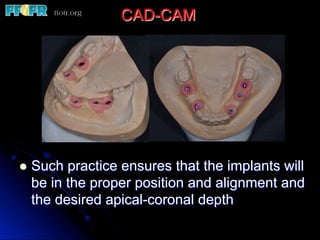 CAD-CAM
l  Such practice ensures that the implants will
be in the proper position and alignment and
the desired apical-coronal depth
 