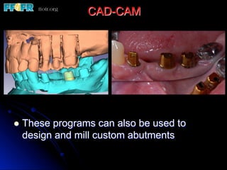 CAD-CAM
l  These programs can also be used to
design and mill custom abutments
 