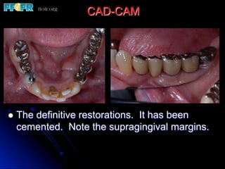 CAD-CAM
l  The definitive restorations. It has been
cemented. Note the supragingival margins.
 