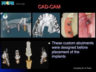 l  These custom abutments
were designed before
placement of the
implants
CAD-CAM
Courtesy Dr. A. Pozzi
 