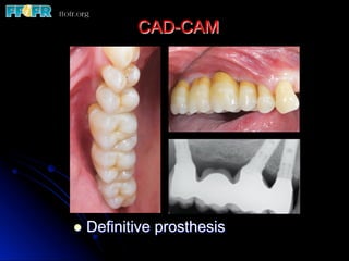 l  Definitive prosthesis
CAD-CAM
 