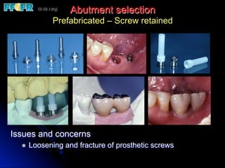 Abutment selection
Prefabricated – Screw retained
Issues and concerns
l  Loosening and fracture of prosthetic screws
 