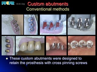 Custom abutments
Conventional methods
l  These custom abutments were designed to
retain the prosthesis with cross pinning screws
 