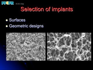Selection of implants
l  Surfaces
l  Geometric designs
 