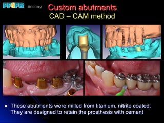 Custom abutments
CAD – CAM method
l  These abutments were milled from titanium, nitrite coated.
They are designed to retain the prosthesis with cement
 
